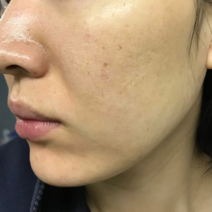 Nオーガニック_現在の肌