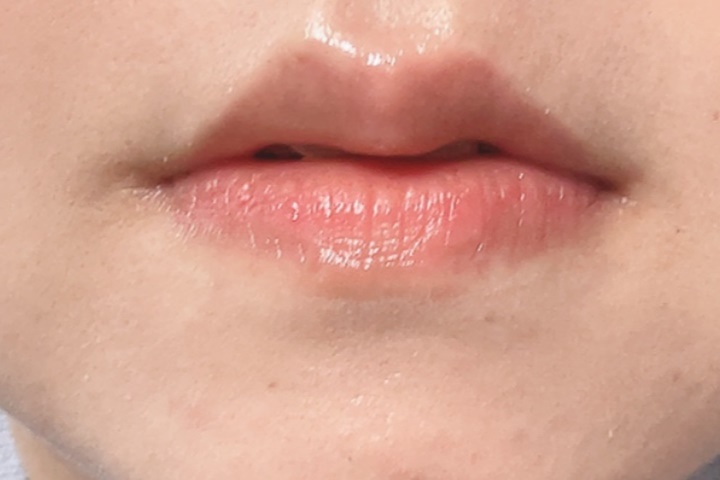 romand唇のシワ